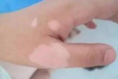 手上的白癜风在什么时候诊疗是好的呢？