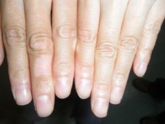 你手上的白癜风还不知道诊疗吗?来看看这里!