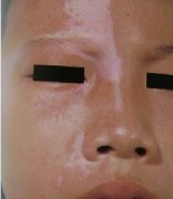 杭州青少年的白癜风诊疗上面要注意什么呢