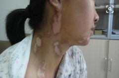 杭州背部白癜风是如何造成的呢