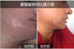 杭州哪些因素影响着胸部白癜风的诊疗啊