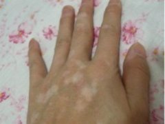 杭州男性早点诊疗白癜风有什么好处呢
