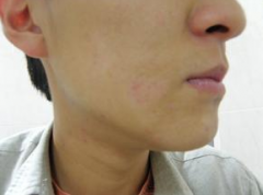 杭州男性脸部白癜风早期能治愈吗