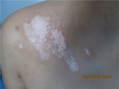 杭州男性泛发型白癜风早期症状怎么治呢