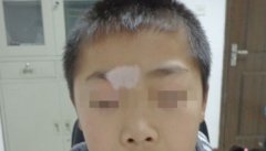 <b>杭州节段型白癜风要如何怎么诊疗好呢</b>