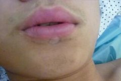<b>杭州肢端型白癜风要如何诊疗好呢</b>