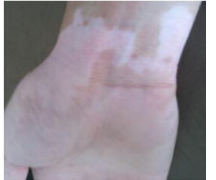 <b>杭州孩子的白癜风该如何治</b>