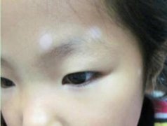 <b>杭州白癜风发生出现后多久才会进稳定期呢</b>