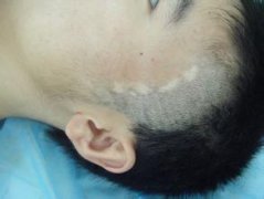 散发型白癜风需要忌口吗